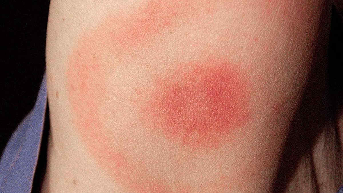 Malattia di Lyme: tutti i sintomi a cui dovresti prestare attenzione dopo una passeggiata nei boschi (e non solo)